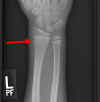 X-Ray_w_Arrow_crop.jpg (131204 bytes)